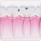 虫歯のステージC1