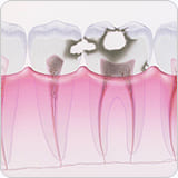 虫歯のステージC3