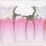 虫歯のステージC4