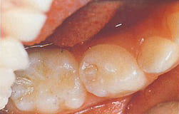 奥歯の歯と歯の間の虫歯　初期