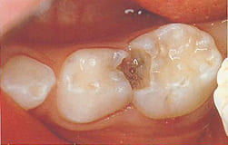 奥歯の歯と歯の間の虫歯　大きな穴があいた