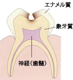象牙質までの虫歯｜C2