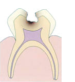 歯髄に達する虫歯｜C2〜C3