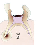 歯髄を伝って根の先まで感染した虫歯｜C3〜C4