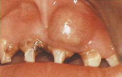 歯の進行とその症状
