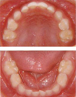 第2乳臼歯がかみ合い乳歯列の完成期