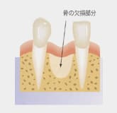 山本歯科医院【インプラントと外科手術】骨の欠損