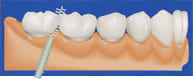 山本歯科医院【インプラントのメンテナンス】歯間ブラシを使用します
