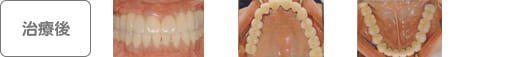 山本歯科医院【インプラントの治療実例】治療後：正面／上顎／下顎