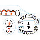 子供の歯・乳歯の虫歯と治療法