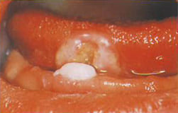 図4：先天歯と舌の潰瘍