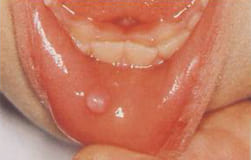 図5：下唇の内側にできた粘液嚢胞