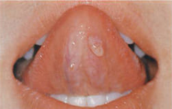 図6：舌の裏側にできた粘液嚢胞 