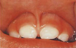 図7：上唇小帯の付着異常　生後10ヶ月 