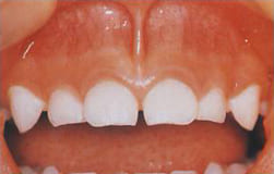 図9：歯から離れた正常な上唇小帯　2歳6ヶ月