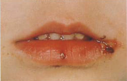 図12：口唇ヘルペス