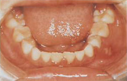 図13：ヘルペス性歯肉口内炎