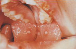図14：歯ぐきと舌の白い部分がアフタです