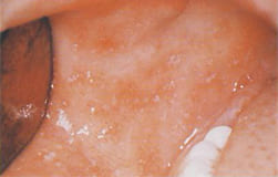 図15：麻疹による小さな白斑（Koplik斑）