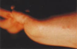 図16：手足口病による足の水疱