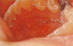 図17：手足口病による舌下部のアフタ 