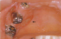 図3：歯肉に潰瘍を伴った硬靭な腫脹