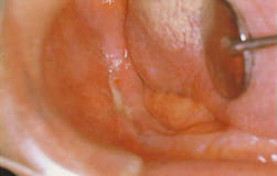 図4：左側下顎臼歯部に不規則な深い潰瘍