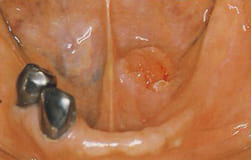 図5：左側口底部に凹凸不整,肉芽様の潰瘍を伴った腫脹