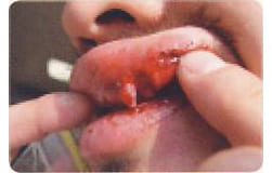 口唇粘膜の損傷