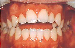 図6-1：前歯で物をかみ切れない開咬