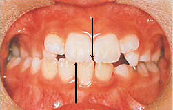 図7：奥歯がずれて逆に咬んでいる交叉咬合