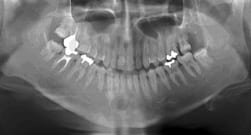 歯の移植症例：1-2
