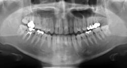 歯の移植症例：1-3