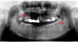 歯の移植症例：2-1