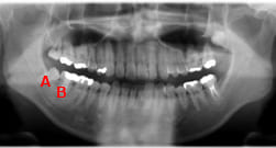 歯の移植症例：3-1