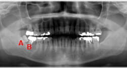 歯の移植症例：4-1
