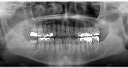歯の移植症例：4-2