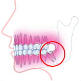 Fig4：歯肉が腫れる