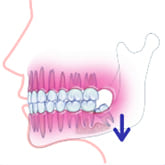 Fig7：骨の吸収が始まり歯周病になる