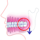 Fig8：骨の吸収が始まり歯周病になる