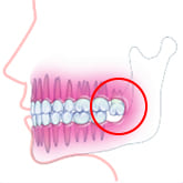 Fig9：上の親知らず歯が伸び下の歯茎を噛んでしまう