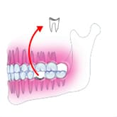 Fig12-1：臼歯の虫歯を抜く